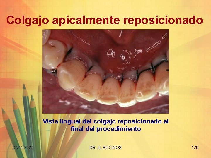 Colgajo apicalmente reposicionado Vista lingual del colgajo reposicionado al final del procedimiento 27/11/2020 DR.