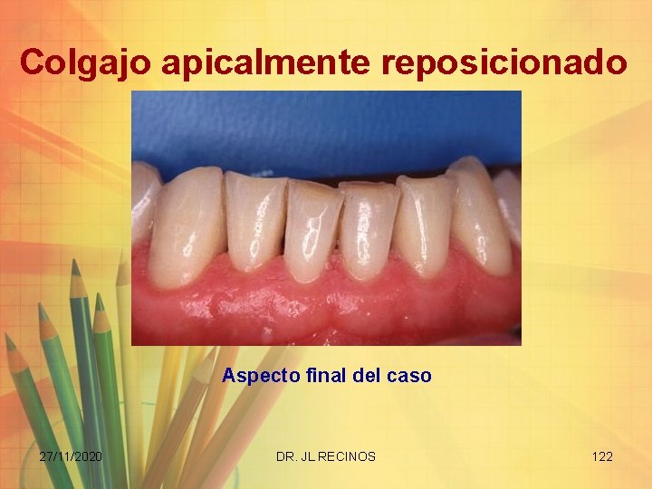 Colgajo apicalmente reposicionado Aspecto final del caso 27/11/2020 DR. JL RECINOS 122 