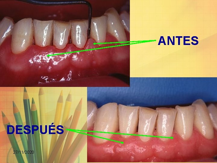 ANTES DESPUÉS 27/11/2020 DR. JL RECINOS 123 