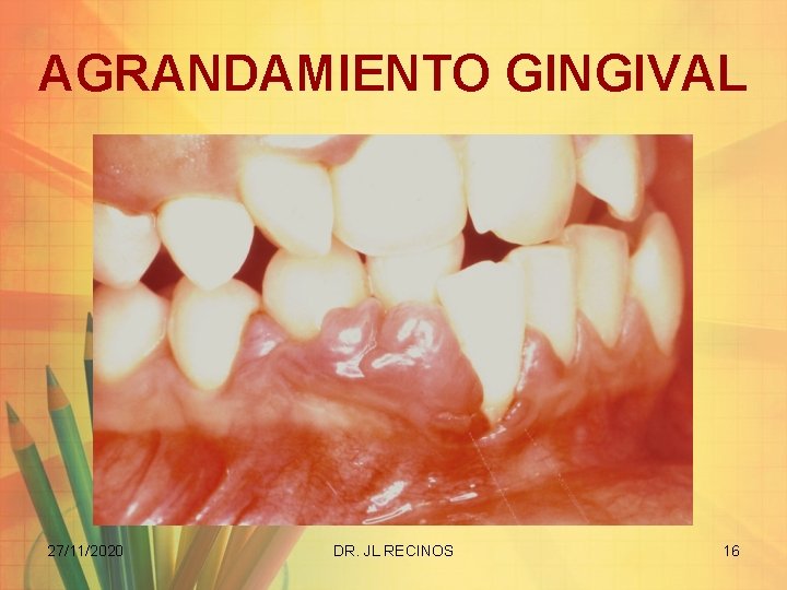 AGRANDAMIENTO GINGIVAL 27/11/2020 DR. JL RECINOS 16 