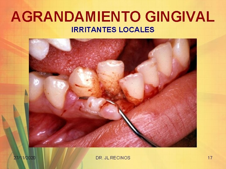 AGRANDAMIENTO GINGIVAL IRRITANTES LOCALES 27/11/2020 DR. JL RECINOS 17 