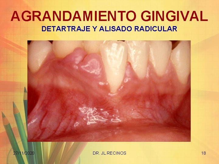 AGRANDAMIENTO GINGIVAL DETARTRAJE Y ALISADO RADICULAR 27/11/2020 DR. JL RECINOS 18 