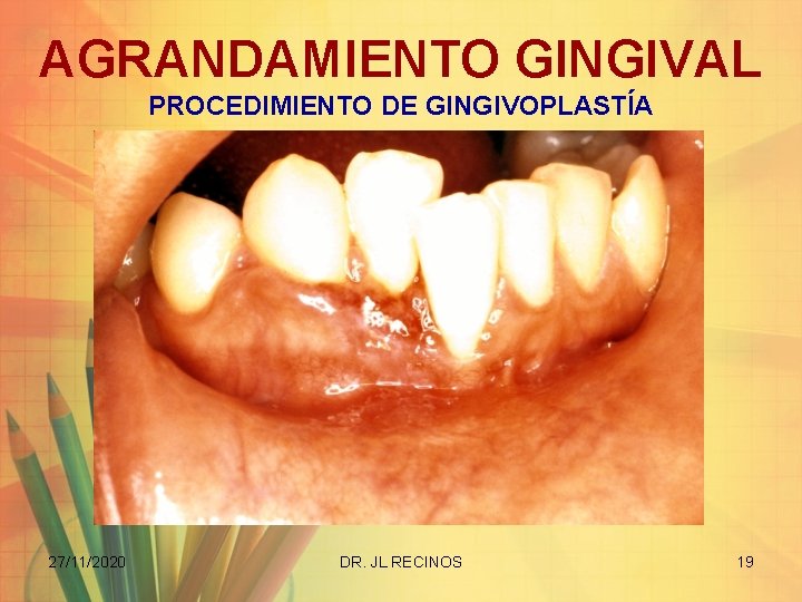 AGRANDAMIENTO GINGIVAL PROCEDIMIENTO DE GINGIVOPLASTÍA 27/11/2020 DR. JL RECINOS 19 