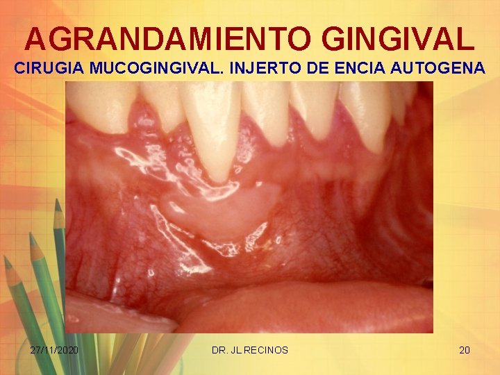 AGRANDAMIENTO GINGIVAL CIRUGIA MUCOGINGIVAL. INJERTO DE ENCIA AUTOGENA 27/11/2020 DR. JL RECINOS 20 