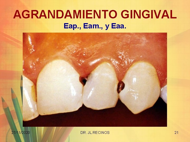 AGRANDAMIENTO GINGIVAL Eap. , Eam. , y Eaa. 27/11/2020 DR. JL RECINOS 21 
