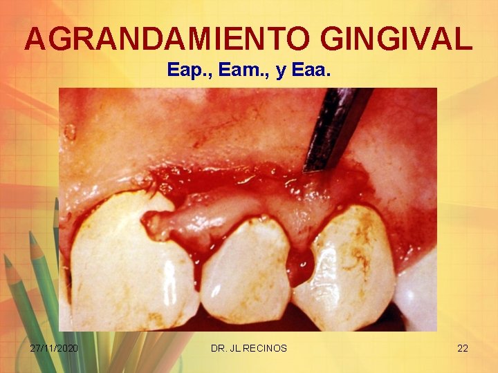 AGRANDAMIENTO GINGIVAL Eap. , Eam. , y Eaa. 27/11/2020 DR. JL RECINOS 22 