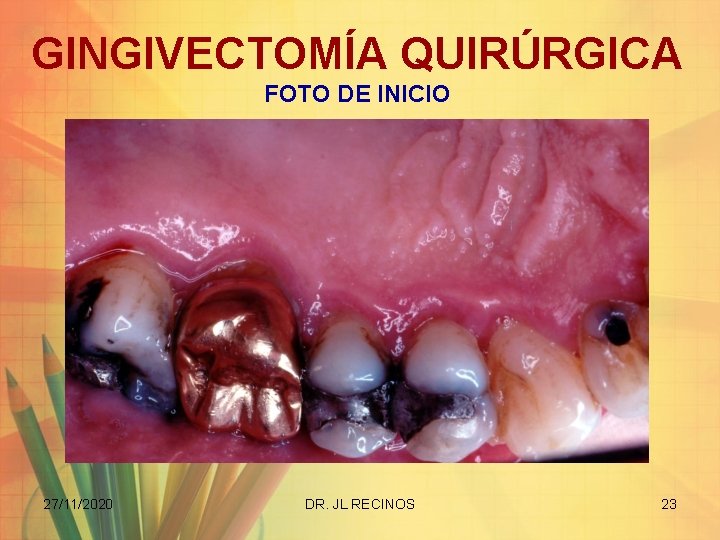 GINGIVECTOMÍA QUIRÚRGICA FOTO DE INICIO 27/11/2020 DR. JL RECINOS 23 