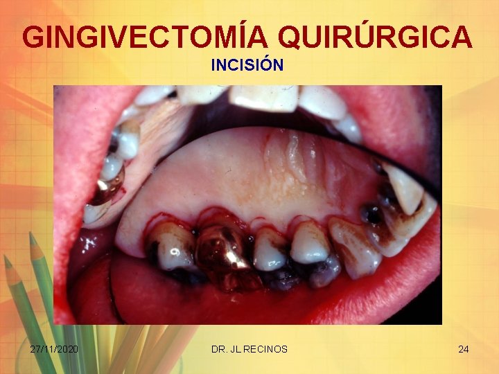 GINGIVECTOMÍA QUIRÚRGICA INCISIÓN 27/11/2020 DR. JL RECINOS 24 