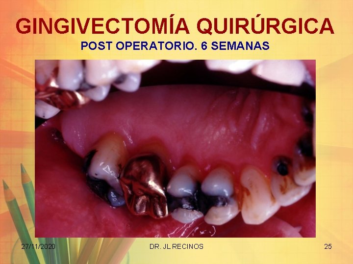 GINGIVECTOMÍA QUIRÚRGICA POST OPERATORIO. 6 SEMANAS 27/11/2020 DR. JL RECINOS 25 