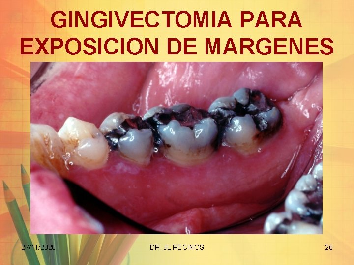 GINGIVECTOMIA PARA EXPOSICION DE MARGENES 27/11/2020 DR. JL RECINOS 26 