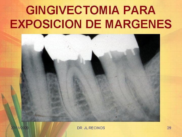 GINGIVECTOMIA PARA EXPOSICION DE MARGENES 27/11/2020 DR. JL RECINOS 29 