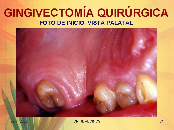 GINGIVECTOMÍA QUIRÚRGICA FOTO DE INICIO. VISTA PALATAL 27/11/2020 DR. JL RECINOS 31 