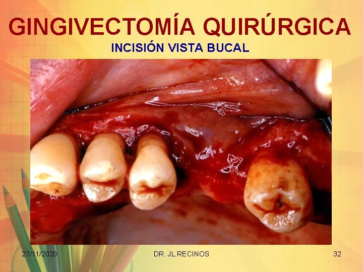 GINGIVECTOMÍA QUIRÚRGICA INCISIÓN VISTA BUCAL 27/11/2020 DR. JL RECINOS 32 