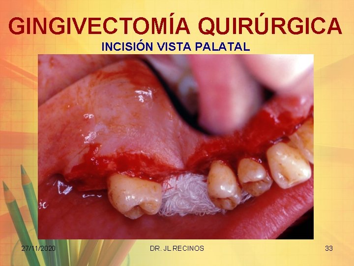 GINGIVECTOMÍA QUIRÚRGICA INCISIÓN VISTA PALATAL 27/11/2020 DR. JL RECINOS 33 