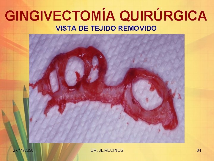 GINGIVECTOMÍA QUIRÚRGICA VISTA DE TEJIDO REMOVIDO 27/11/2020 DR. JL RECINOS 34 