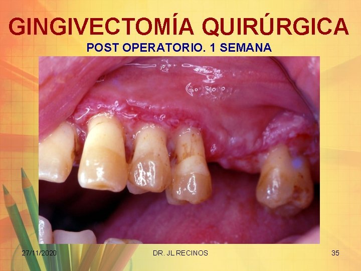 GINGIVECTOMÍA QUIRÚRGICA POST OPERATORIO. 1 SEMANA 27/11/2020 DR. JL RECINOS 35 