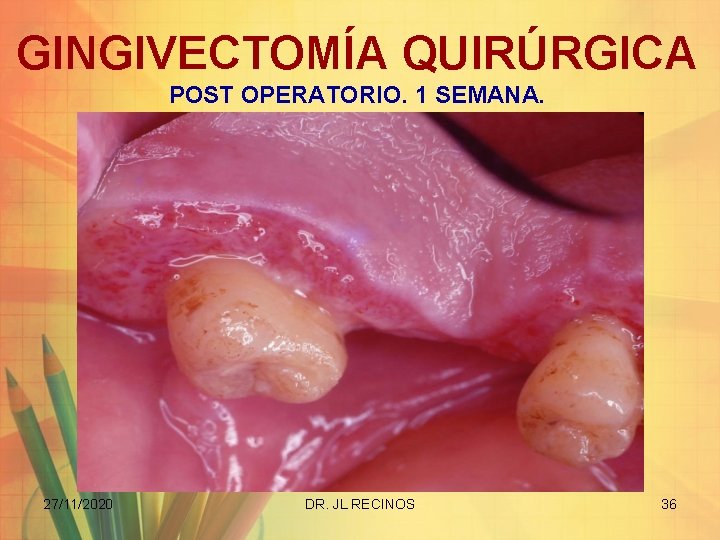 GINGIVECTOMÍA QUIRÚRGICA POST OPERATORIO. 1 SEMANA. 27/11/2020 DR. JL RECINOS 36 