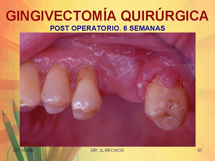 GINGIVECTOMÍA QUIRÚRGICA POST OPERATORIO. 6 SEMANAS 27/11/2020 DR. JL RECINOS 37 