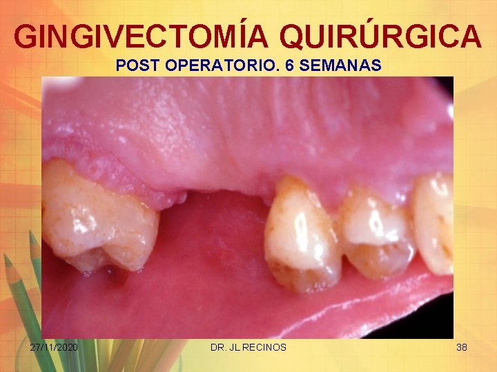 GINGIVECTOMÍA QUIRÚRGICA POST OPERATORIO. 6 SEMANAS 27/11/2020 DR. JL RECINOS 38 