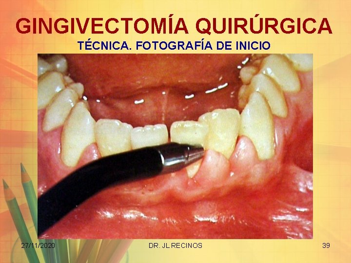 GINGIVECTOMÍA QUIRÚRGICA TÉCNICA. FOTOGRAFÍA DE INICIO 27/11/2020 DR. JL RECINOS 39 