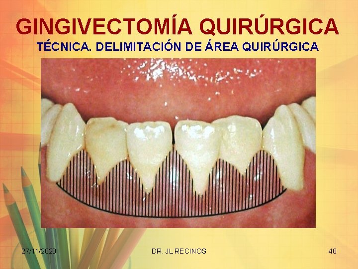 GINGIVECTOMÍA QUIRÚRGICA TÉCNICA. DELIMITACIÓN DE ÁREA QUIRÚRGICA 27/11/2020 DR. JL RECINOS 40 