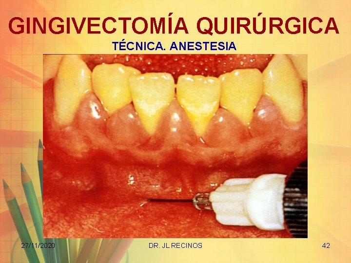 GINGIVECTOMÍA QUIRÚRGICA TÉCNICA. ANESTESIA 27/11/2020 DR. JL RECINOS 42 