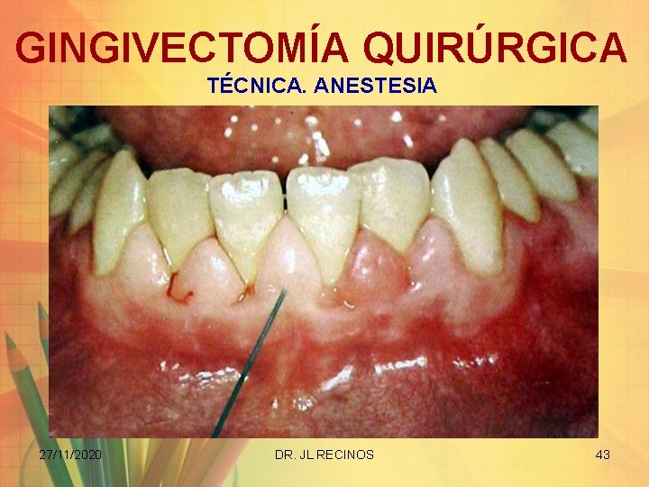 GINGIVECTOMÍA QUIRÚRGICA TÉCNICA. ANESTESIA 27/11/2020 DR. JL RECINOS 43 