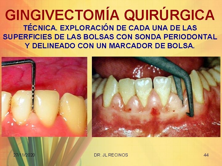 GINGIVECTOMÍA QUIRÚRGICA TÉCNICA. EXPLORACIÓN DE CADA UNA DE LAS SUPERFICIES DE LAS BOLSAS CON