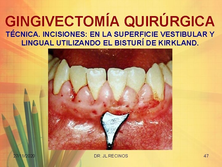 GINGIVECTOMÍA QUIRÚRGICA TÉCNICA. INCISIONES: EN LA SUPERFICIE VESTIBULAR Y LINGUAL UTILIZANDO EL BISTURÍ DE