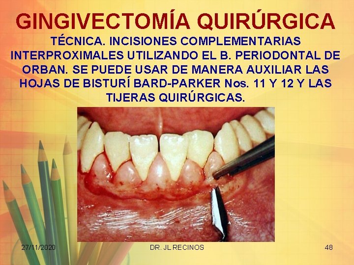 GINGIVECTOMÍA QUIRÚRGICA TÉCNICA. INCISIONES COMPLEMENTARIAS INTERPROXIMALES UTILIZANDO EL B. PERIODONTAL DE ORBAN. SE PUEDE