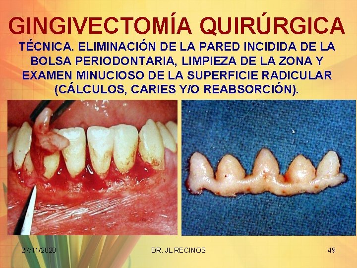 GINGIVECTOMÍA QUIRÚRGICA TÉCNICA. ELIMINACIÓN DE LA PARED INCIDIDA DE LA BOLSA PERIODONTARIA, LIMPIEZA DE