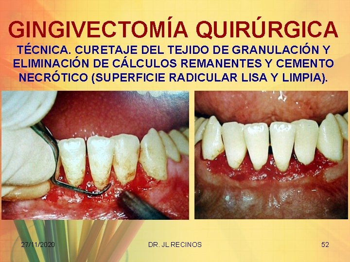 GINGIVECTOMÍA QUIRÚRGICA TÉCNICA. CURETAJE DEL TEJIDO DE GRANULACIÓN Y ELIMINACIÓN DE CÁLCULOS REMANENTES Y