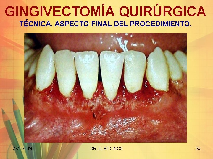 GINGIVECTOMÍA QUIRÚRGICA TÉCNICA. ASPECTO FINAL DEL PROCEDIMIENTO. 27/11/2020 DR. JL RECINOS 55 