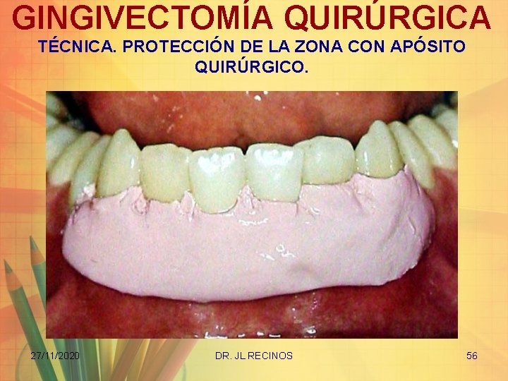 GINGIVECTOMÍA QUIRÚRGICA TÉCNICA. PROTECCIÓN DE LA ZONA CON APÓSITO QUIRÚRGICO. 27/11/2020 DR. JL RECINOS