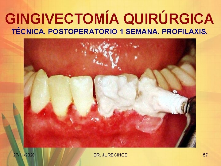 GINGIVECTOMÍA QUIRÚRGICA TÉCNICA. POSTOPERATORIO 1 SEMANA. PROFILAXIS. 27/11/2020 DR. JL RECINOS 57 