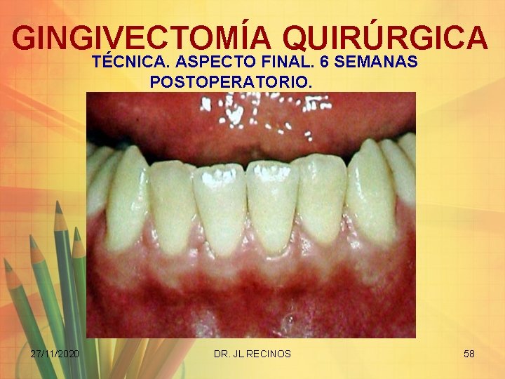 GINGIVECTOMÍA QUIRÚRGICA TÉCNICA. ASPECTO FINAL. 6 SEMANAS POSTOPERATORIO. 27/11/2020 DR. JL RECINOS 58 