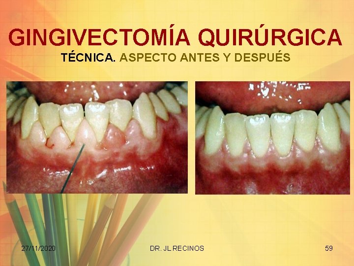 GINGIVECTOMÍA QUIRÚRGICA TÉCNICA. ASPECTO ANTES Y DESPUÉS 27/11/2020 DR. JL RECINOS 59 