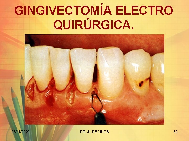 GINGIVECTOMÍA ELECTRO QUIRÚRGICA. 27/11/2020 DR. JL RECINOS 62 