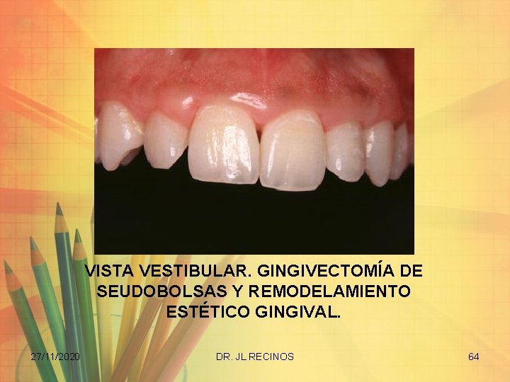 VISTA VESTIBULAR. GINGIVECTOMÍA DE SEUDOBOLSAS Y REMODELAMIENTO ESTÉTICO GINGIVAL. 27/11/2020 DR. JL RECINOS 64