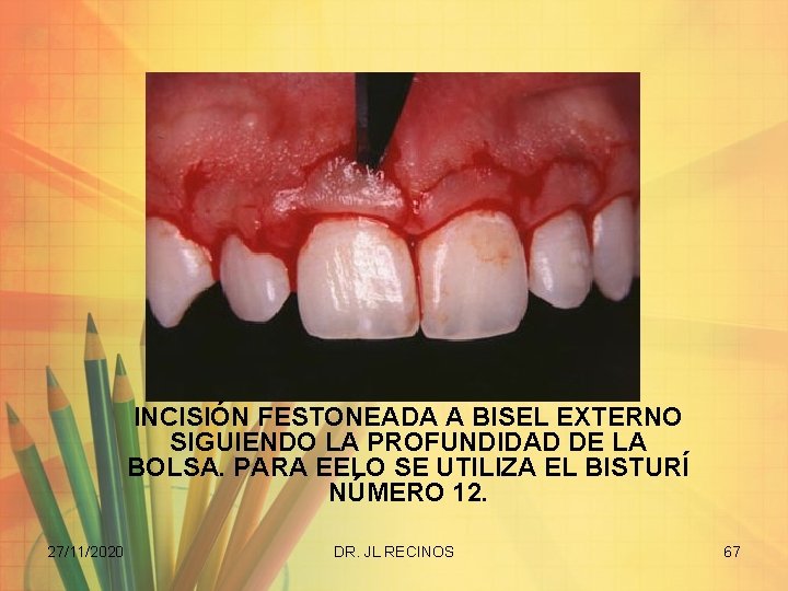 INCISIÓN FESTONEADA A BISEL EXTERNO SIGUIENDO LA PROFUNDIDAD DE LA BOLSA. PARA EELO SE