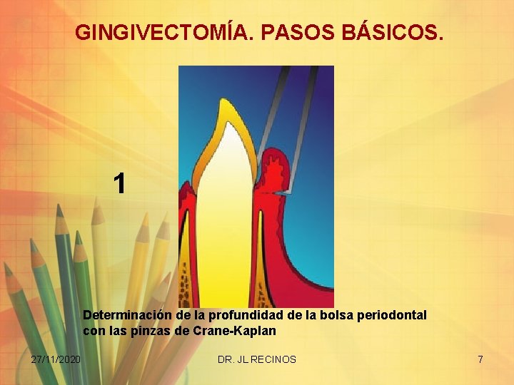 GINGIVECTOMÍA. PASOS BÁSICOS. 1 Determinación de la profundidad de la bolsa periodontal con las