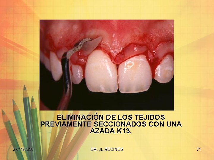 ELIMINACIÓN DE LOS TEJIDOS PREVIAMENTE SECCIONADOS CON UNA AZADA K 13. 27/11/2020 DR. JL