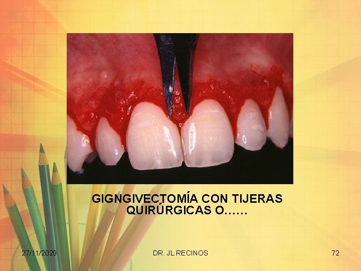 GIGNGIVECTOMÍA CON TIJERAS QUIRÚRGICAS O…… 27/11/2020 DR. JL RECINOS 72 