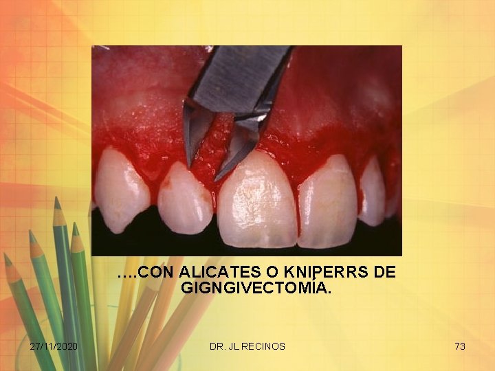 …. CON ALICATES O KNIPERRS DE GIGNGIVECTOMÍA. 27/11/2020 DR. JL RECINOS 73 