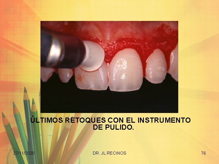 ÚLTIMOS RETOQUES CON EL INSTRUMENTO DE PULIDO. 27/11/2020 DR. JL RECINOS 76 