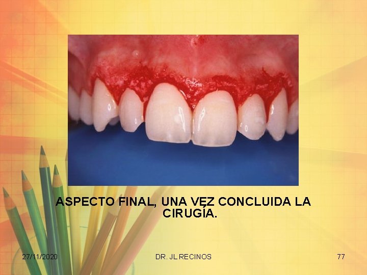 ASPECTO FINAL, UNA VEZ CONCLUIDA LA CIRUGÍA. 27/11/2020 DR. JL RECINOS 77 