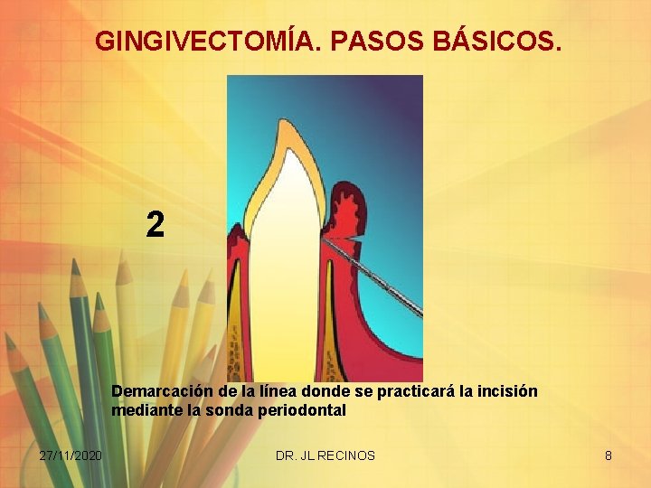 GINGIVECTOMÍA. PASOS BÁSICOS. 2 Demarcación de la línea donde se practicará la incisión mediante