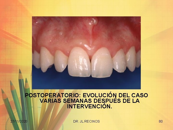 POSTOPERATORIO: EVOLUCIÓN DEL CASO VARIAS SEMANAS DESPUÉS DE LA INTERVENCIÓN. 27/11/2020 DR. JL RECINOS