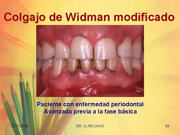 Colgajo de Widman modificado Paciente con enfermedad periodontal Avanzada previa a la fase básica