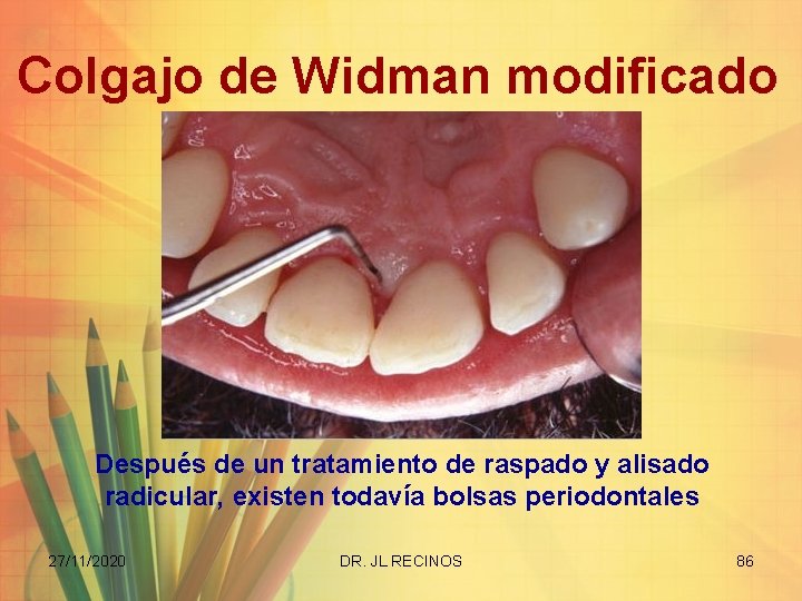 Colgajo de Widman modificado Después de un tratamiento de raspado y alisado radicular, existen